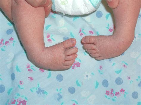 scratch test ctev|Clubfoot (congenital talipes equinovarus) .